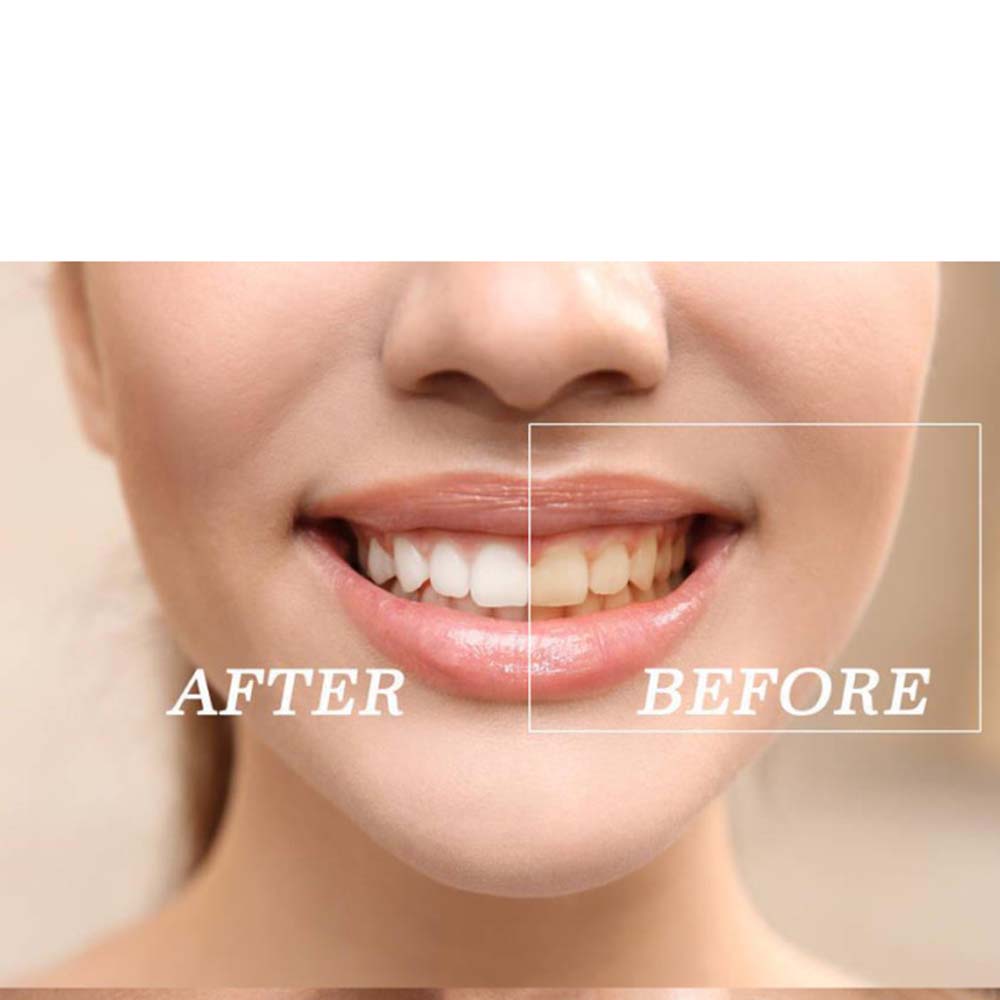Kit de gel para clareamento de - Teeth Whitening Bleaching Kit avaliação e preço