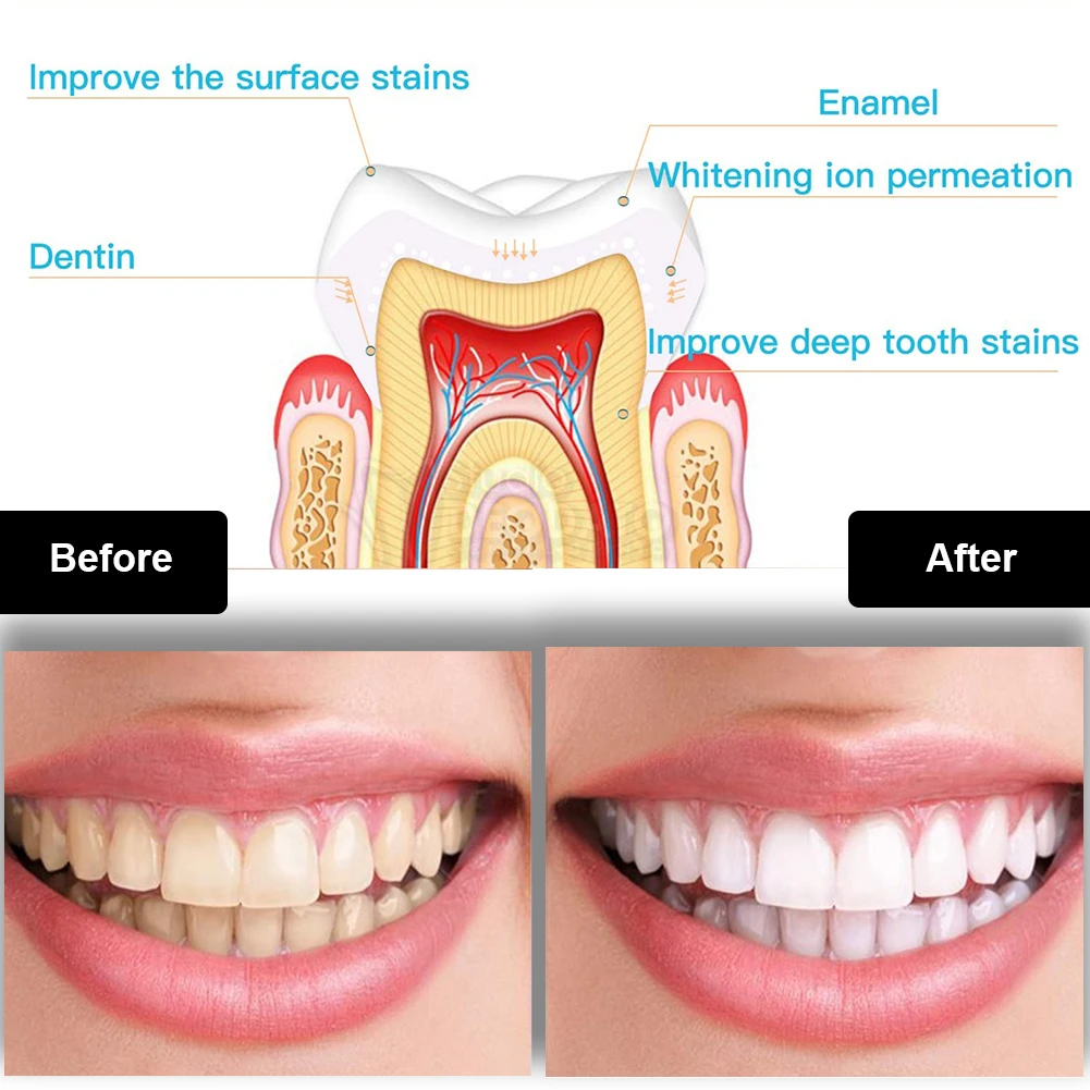 Kit de clareamento dental dos  - Teeth Whitening Price avaliação e preço